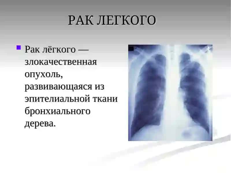 Рак лёгкого 2