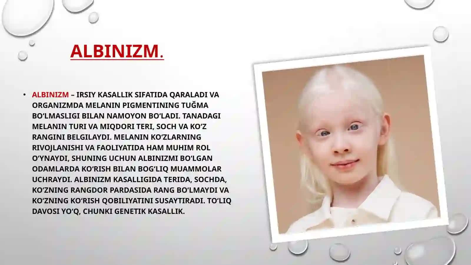 Albinizm. Etiopatogenezi, klinikasi, diagnostikasi, davolash va profilaktikasi 2