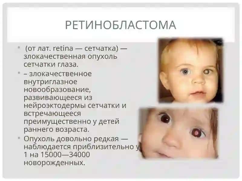 Ретинобластома 2