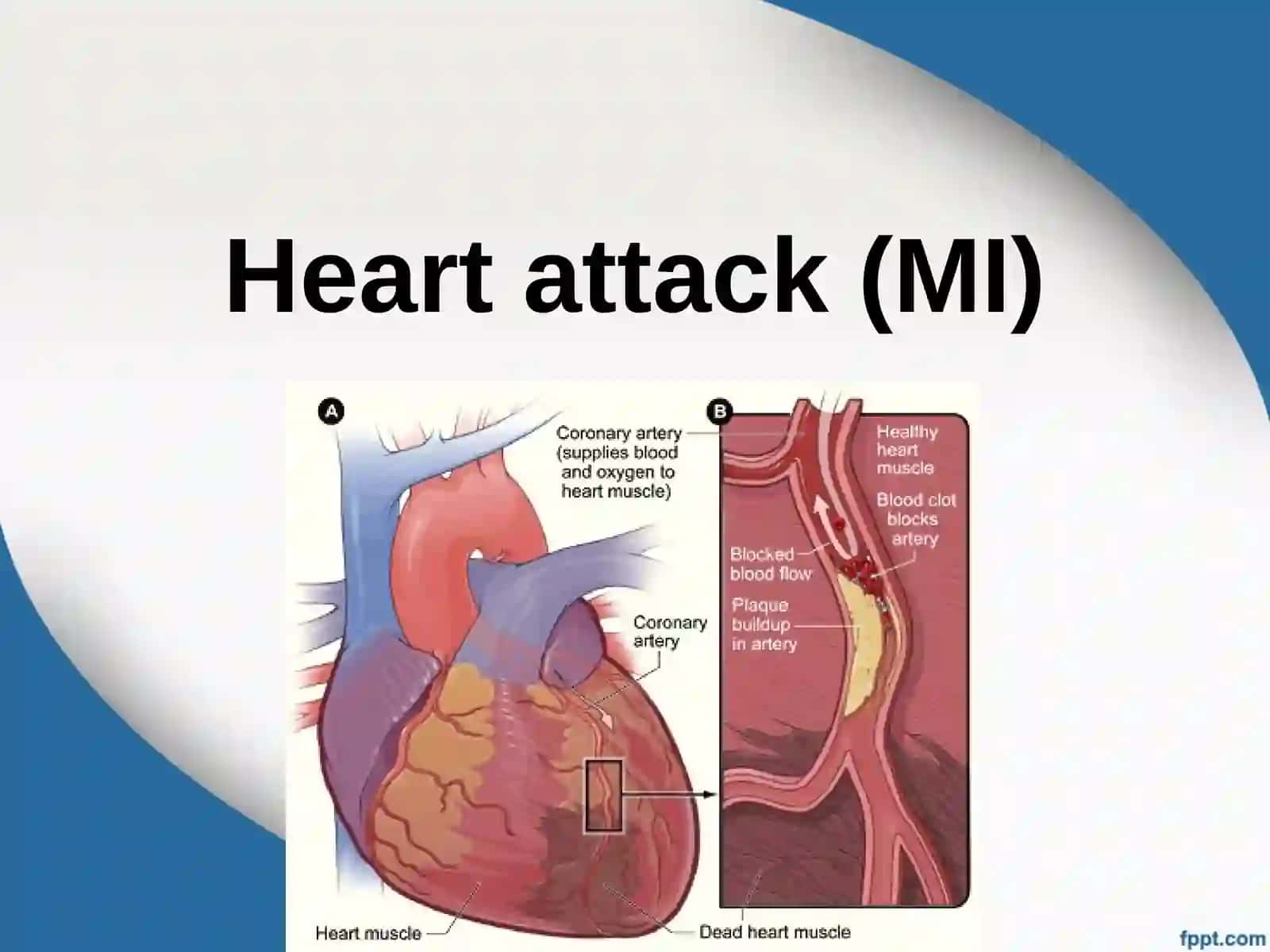 Heart attack (MI) 2