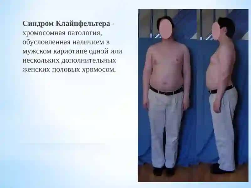 Синдром Клайнфельтера 2