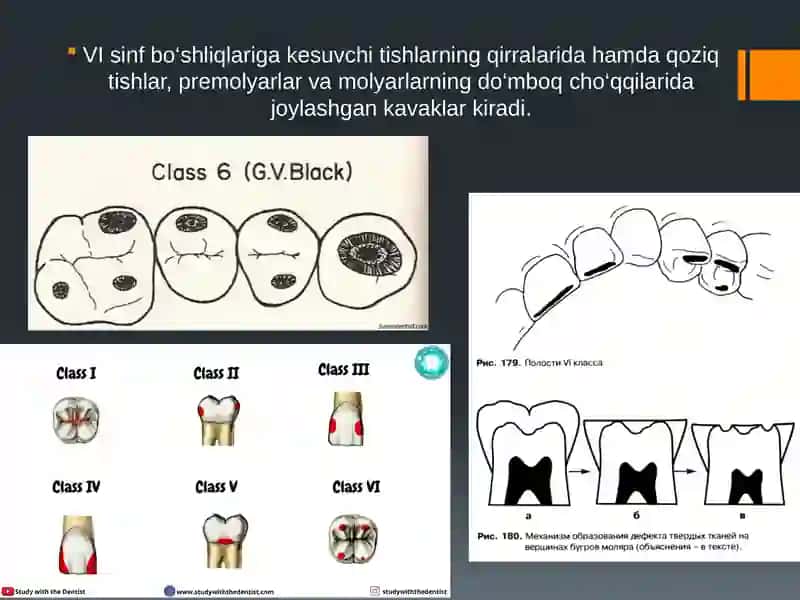 VI sinfli karies kovaklarini restavratsiya qilishning klinik tamoyillari 2