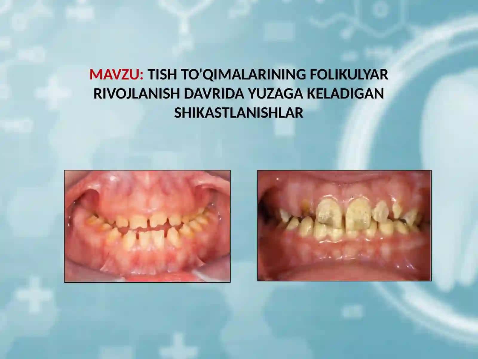 TISH TO'QIMALARINING FOLIKULYAR RIVOJLANISH DAVRIDA YUZAGA KELADIGAN SHIKASTLANISHLAR 2