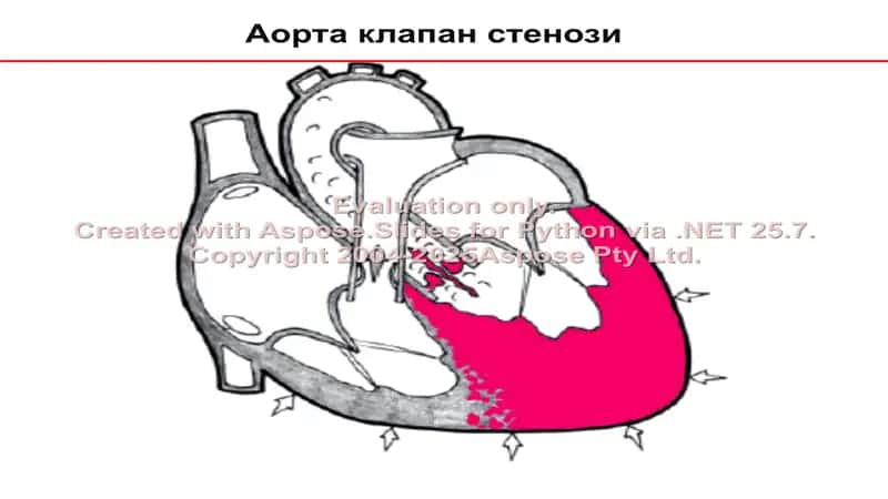 Аорта клапан нуқсонлари 2