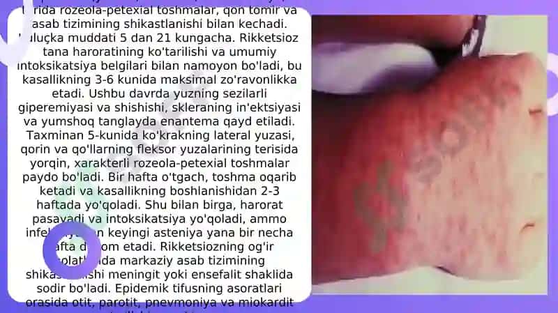 RIKKETSIOZ KLINIKASI 2