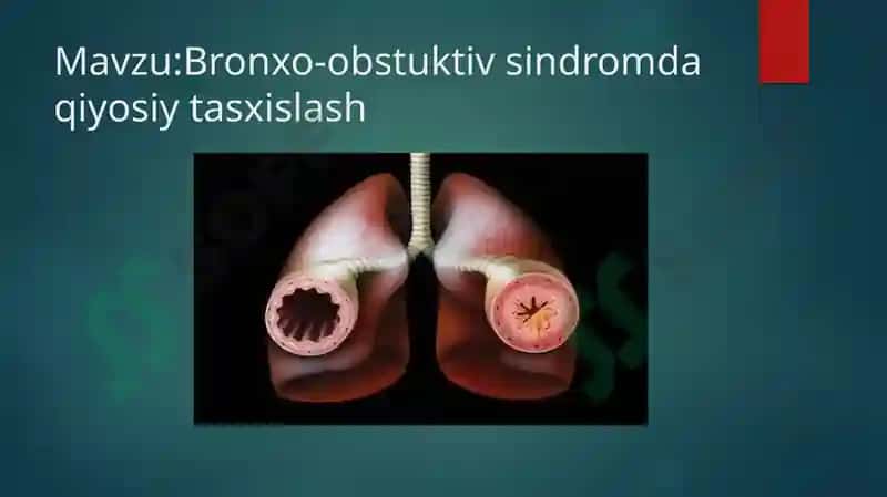 Bronxo-obstuktiv sindromda qiyosiy tasxislash 2