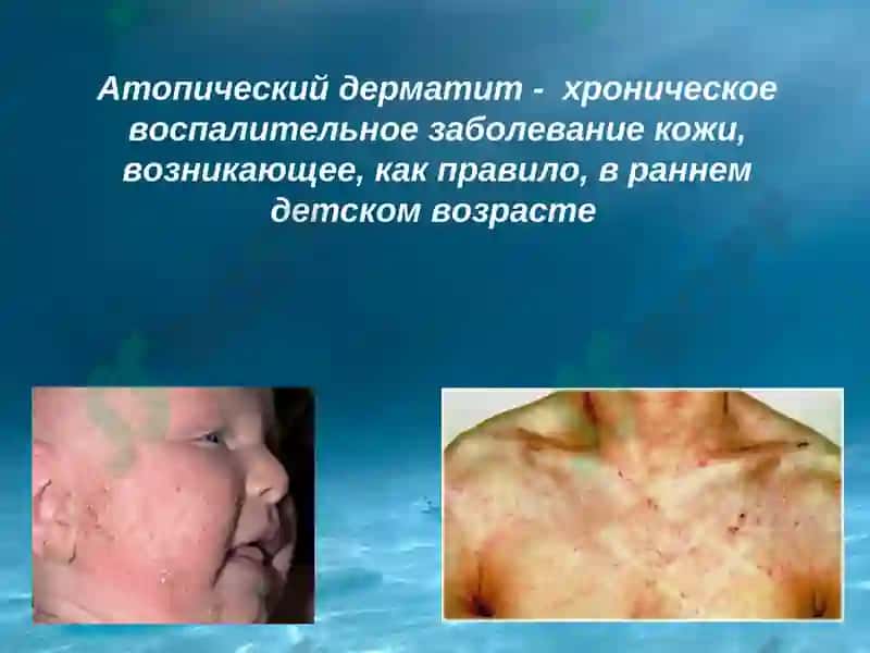 Atopik dermatit 2