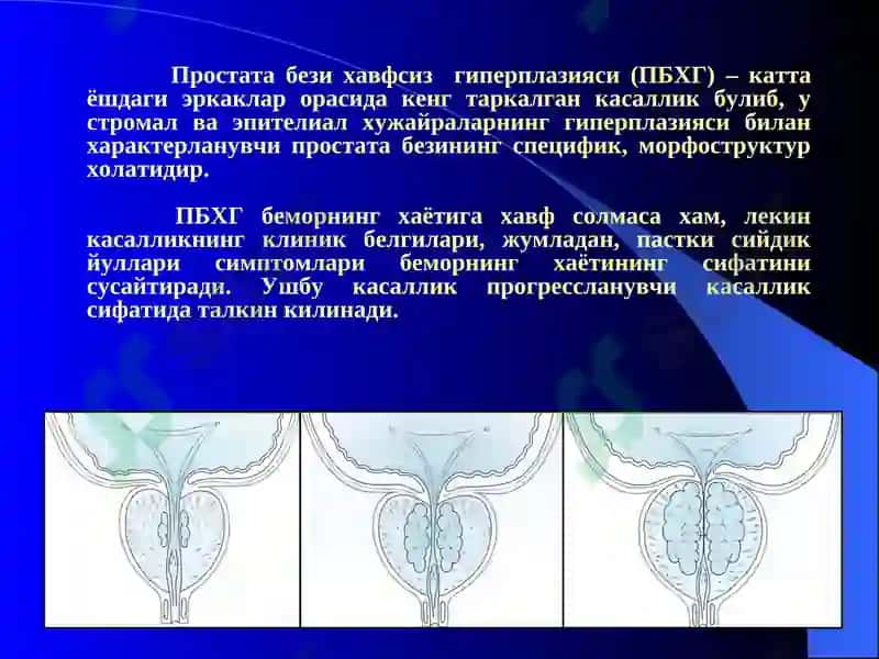 Простата бези хавфсиз гиперплазияси 2