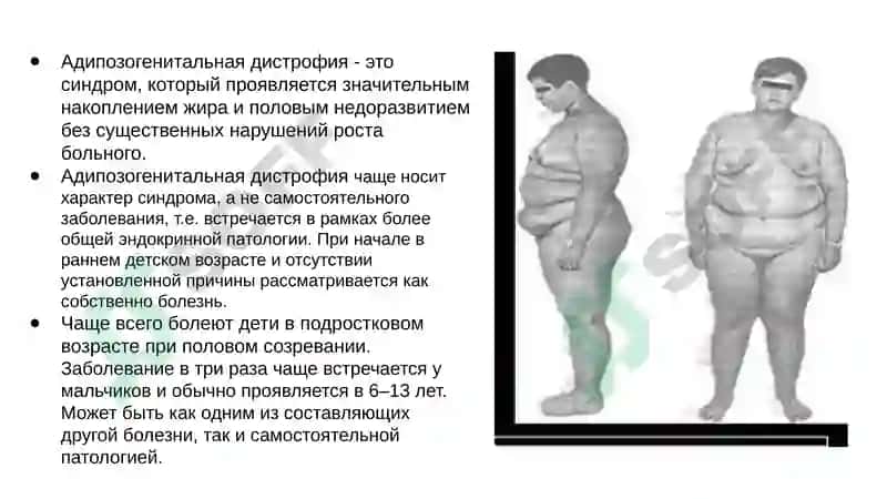 адипозогенитальная дистрофия 2