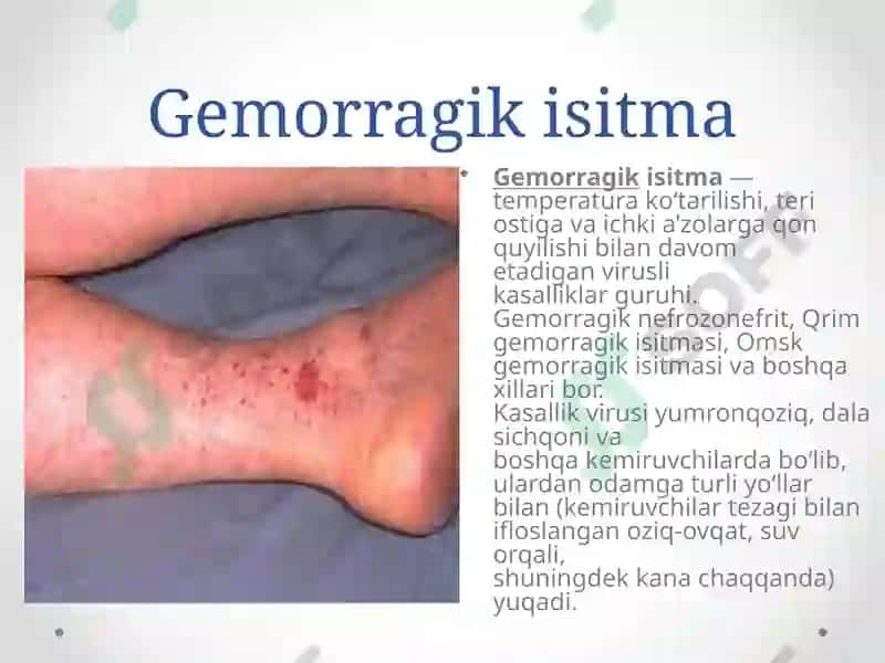 Gemorragik isitma qo`zg`atuvchilari, patoenezi, laboratoriya tashhisi. 2