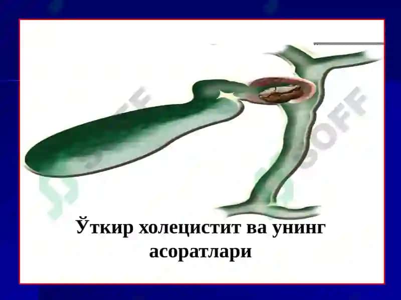 Ўткир Холецистит ва унинг асоратлари 2