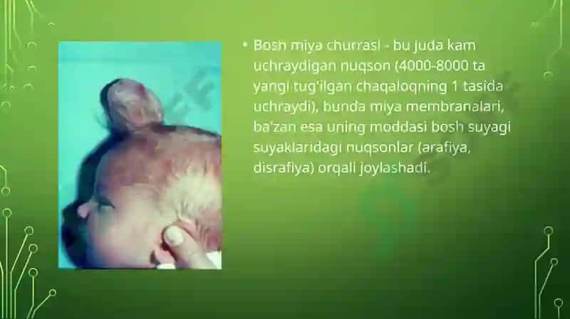TUG'MA NUQSONLAR. BOLALARDA MIYA CHURRASI VA YURAK NUQSONLARI 2