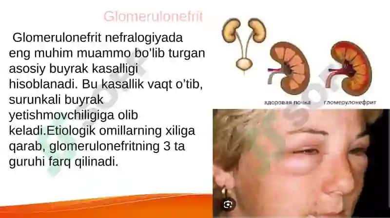 Glomerulonefrit 2