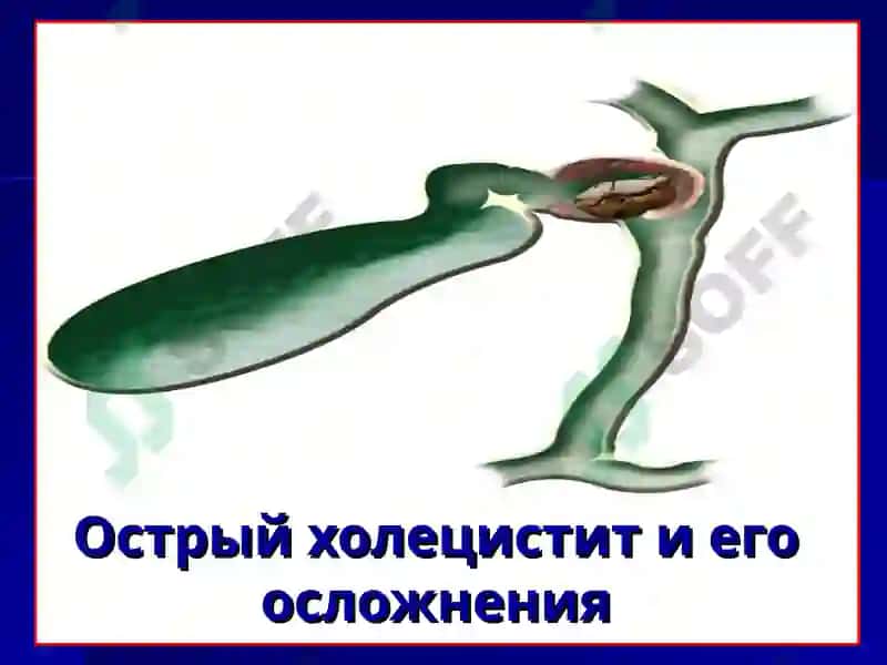Острый холецистит и его осложнения 2