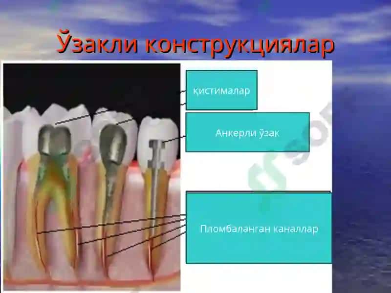 Тиш  тож  қисмининг  қисман ва  тўлиқ йўқотилганда   ўзакли конструкциялар билан тиклаш. 2
