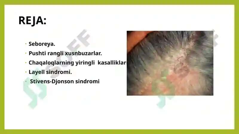 Seboreya. Pushti rangli xusnbuzarlar. Chaqaloqlarning yiringli  kasalliklari. Layell va Stivens-Djonson sindromlari 2