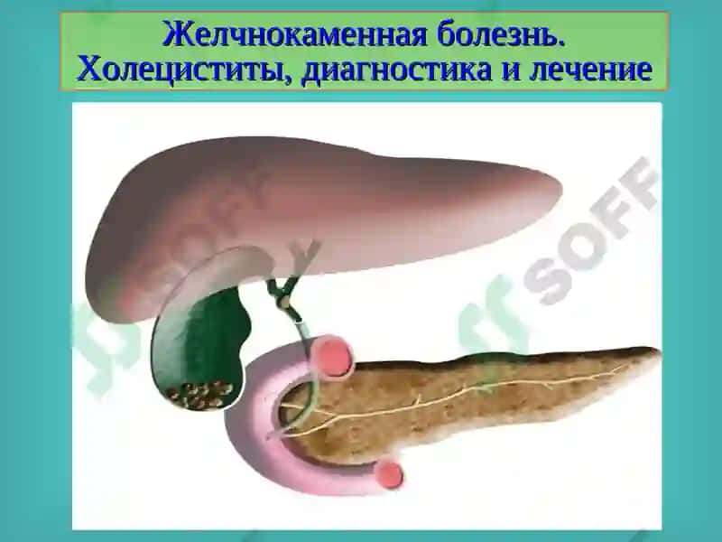 Желчнокаменная болезнь. Холециститы, диагностика и лечение 2