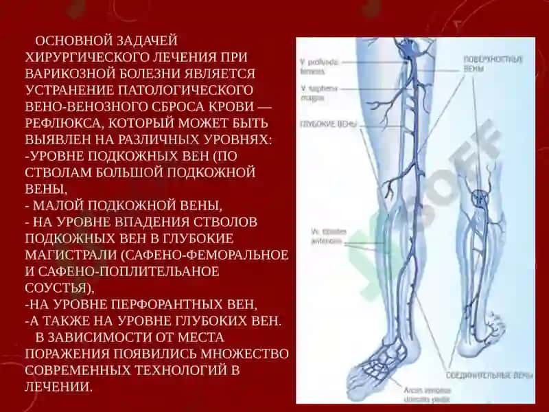 СОВРЕМЕННЫЕ МЕТОДЫ ХИРУРГИЧЕСКОГО ЛЕЧЕНИЯ ВАРИКОЗНОЙ БОЛЕЗНИ НИЖНИХ КОНЕЧНОСТЕЙ 2