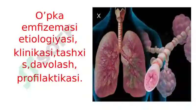 O’PKA EMFIZEMASI 2