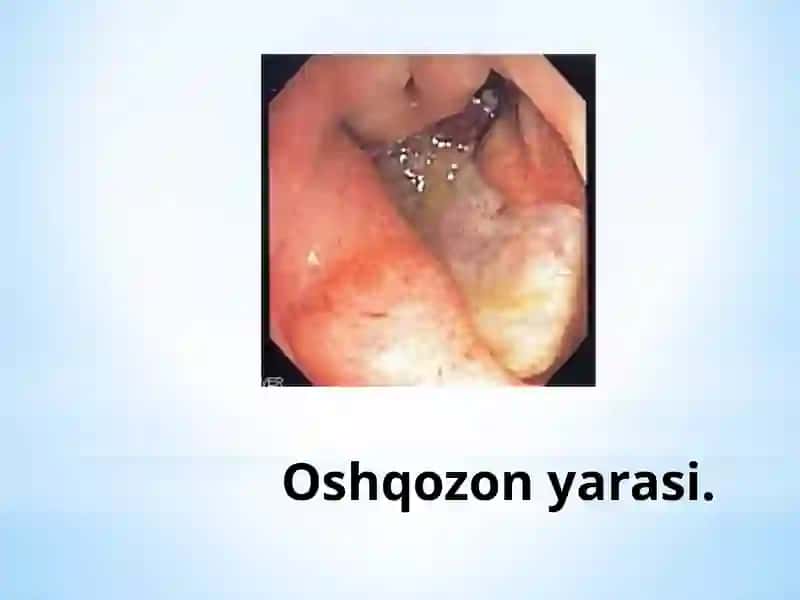 Oshqozon yara kasalligi epiopatogenezi 2