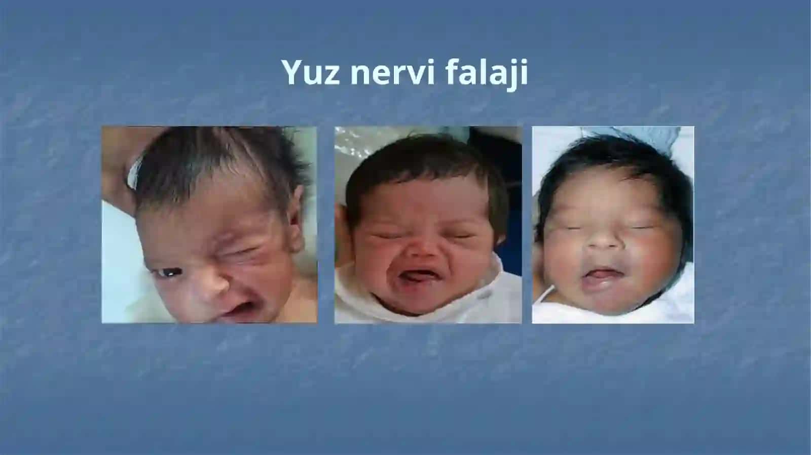 Yuz nervi falaji 2