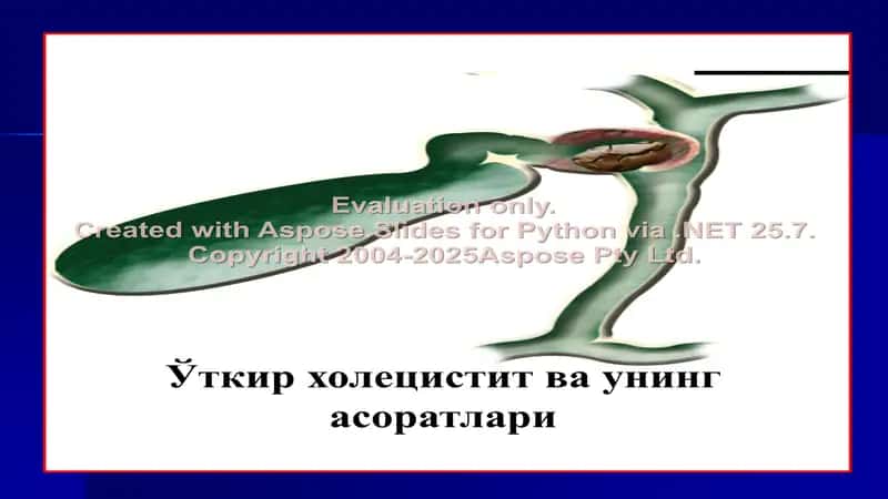 Ўткир холецистит ва унинг асоратлари 2