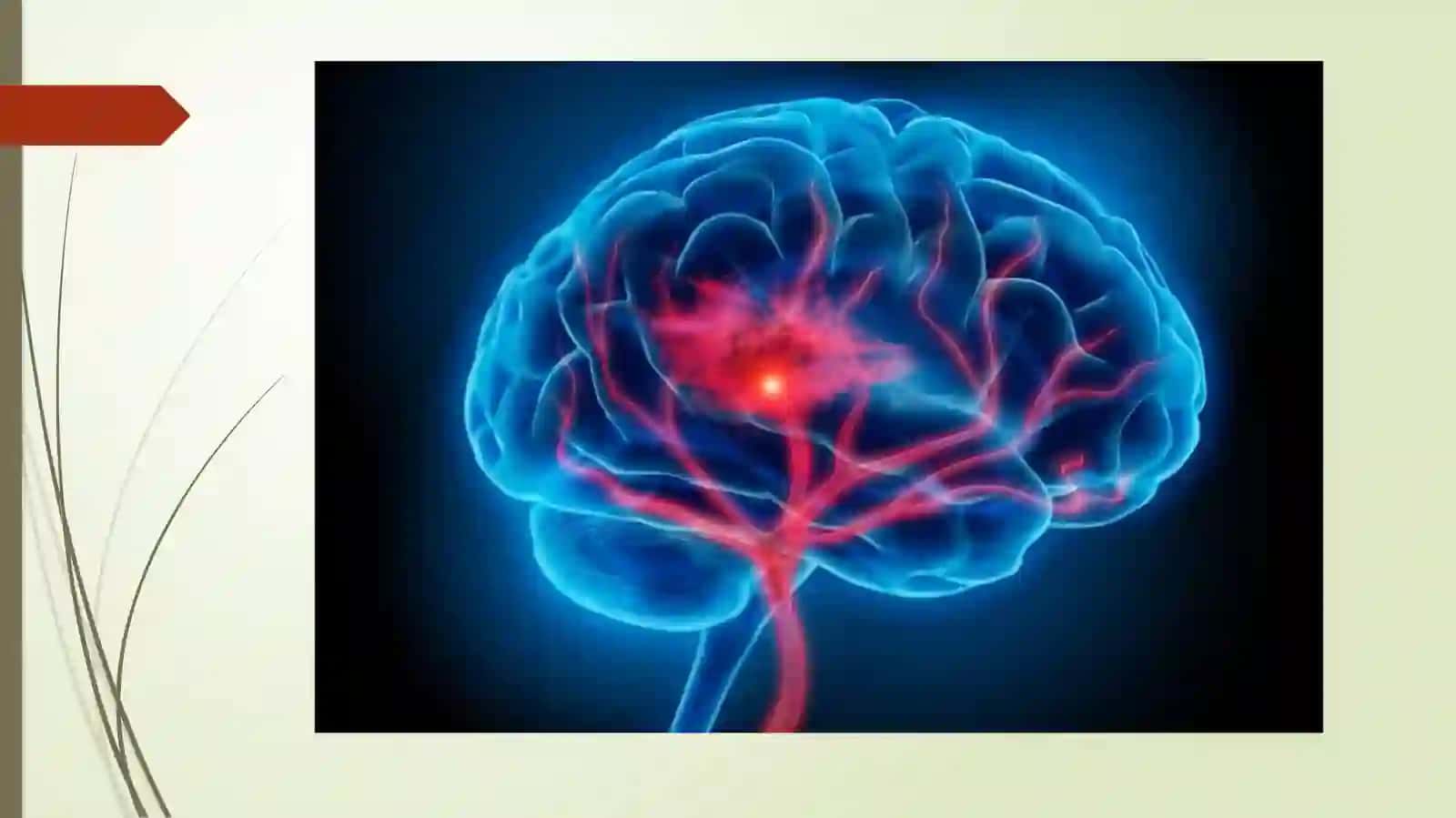 Asabtizimidemiyelinizatsiyalikasalliklari. (tarqoqskleroz,alsgemer, Harrington, parkinsonism,xorea) 2