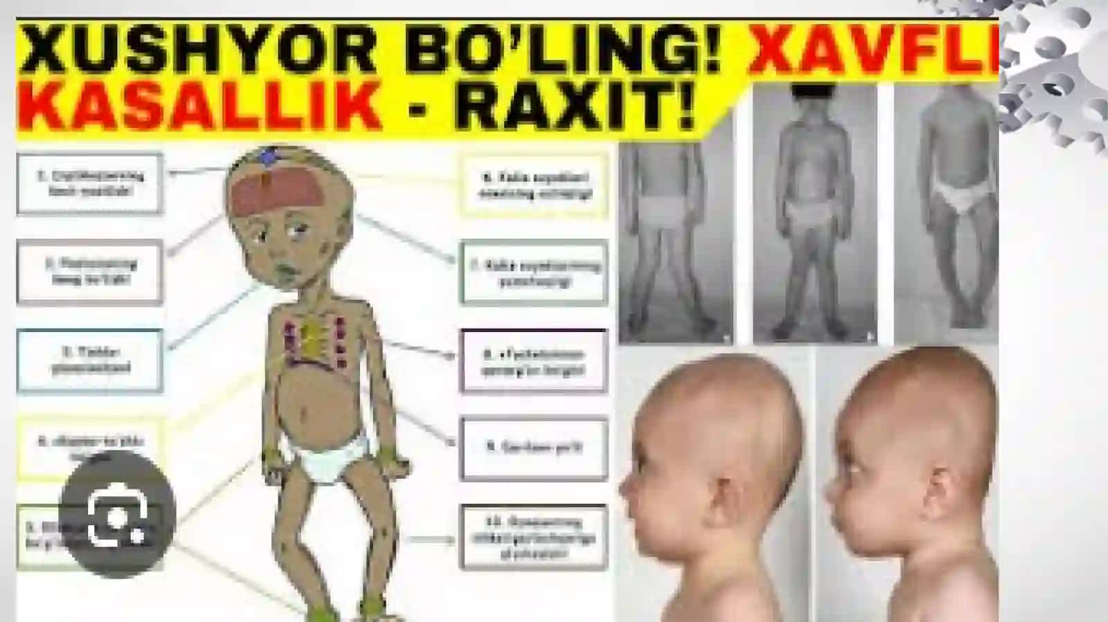 Raxit Kasalligi 2