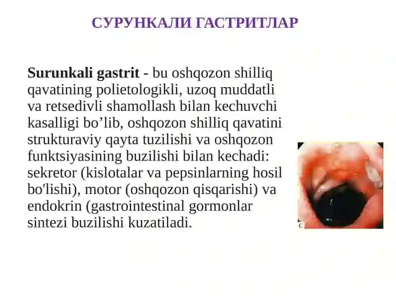 SURUNKALI GASTRITLAR 2