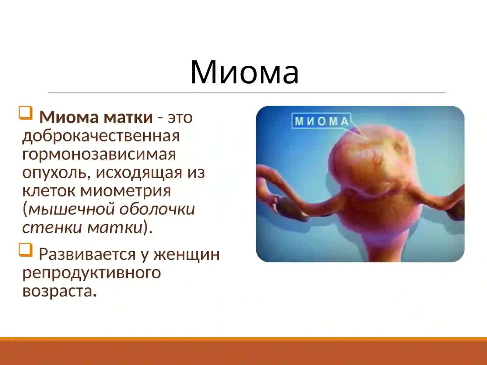 Миома матки 2