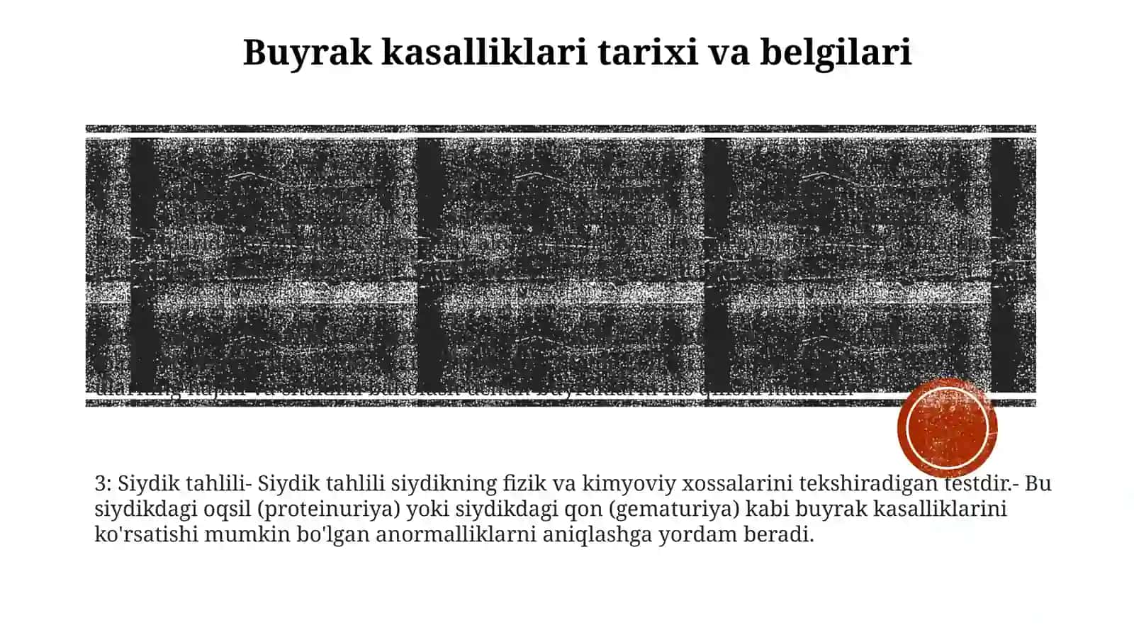 Buyrak Kasalligi Bilan Kasallangan Bemorlarni Tekshirish. So'Rab Surishtirish, Ko'Zdan Kechirish, Buyrak Palpatsigasi Va Perkussiyasi 2