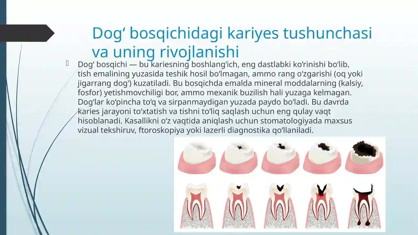 O’TKIR VA SURUNKALI DOG’ BOSQICHIDAGI KARIESNI DAVOLASH USULLARI.RETSEPTURA,KASALLIKNING OLDINI OLISH USULLARI 2
