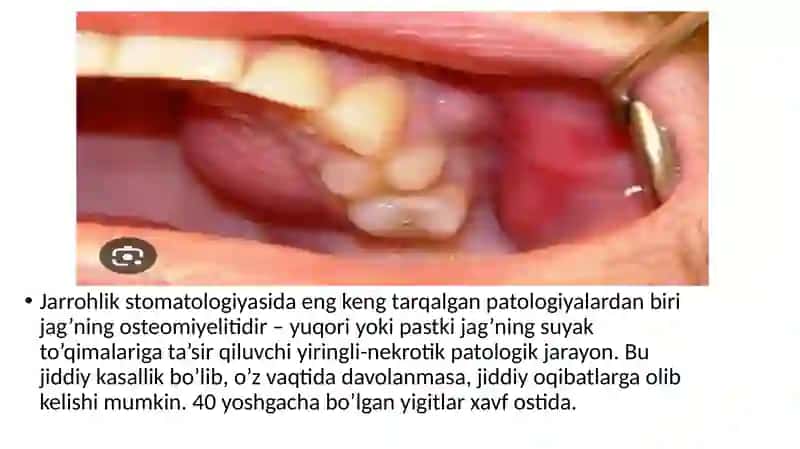 YuqorijağÕtkirosteomiyelitiVaAtrofdagiRivojlanganapsessVaFlegmonalari(Periostit,TanglayAbsessikozKosasi,lunj,Chakkaosti,YanoqSoxalariflegmonalariНормухамбетовКамрон411-C 2