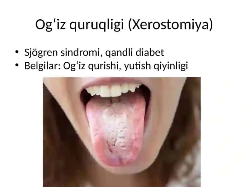 Endokrin kasalliklarda og‘iz bo‘shlig‘ida kuzatiladigan o‘zgarishlar va dispanserizatsiya 2