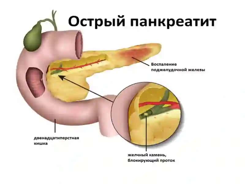 Pankreatit klassifikatsiyasi 2