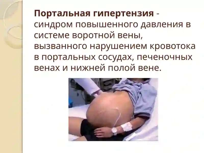 Портальная гипертензия 2