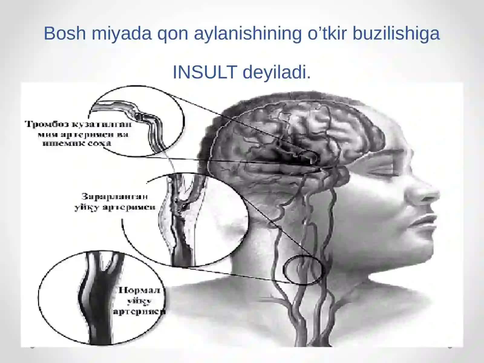 Ishemik insult 2