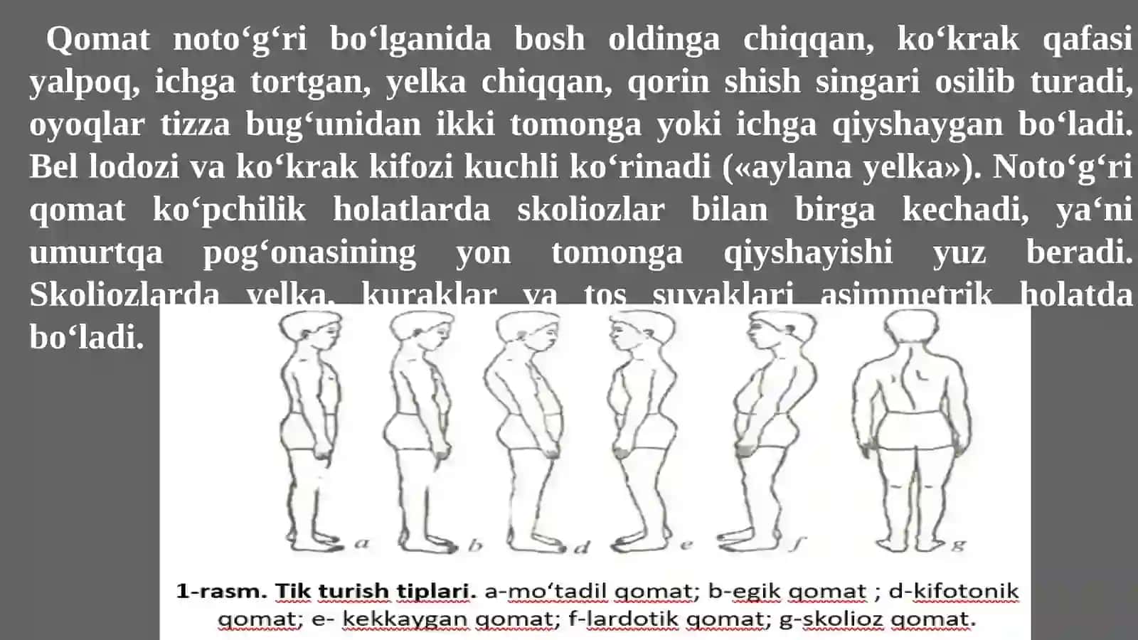 Bolalardaqaddi qomatning shakllanishi vakamchiliklari 3