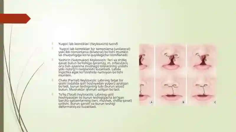 Tug'ma lab va tanglay kemtiklari 3
