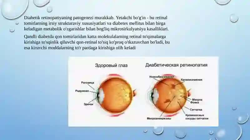 Diabetik retinopatiya 3