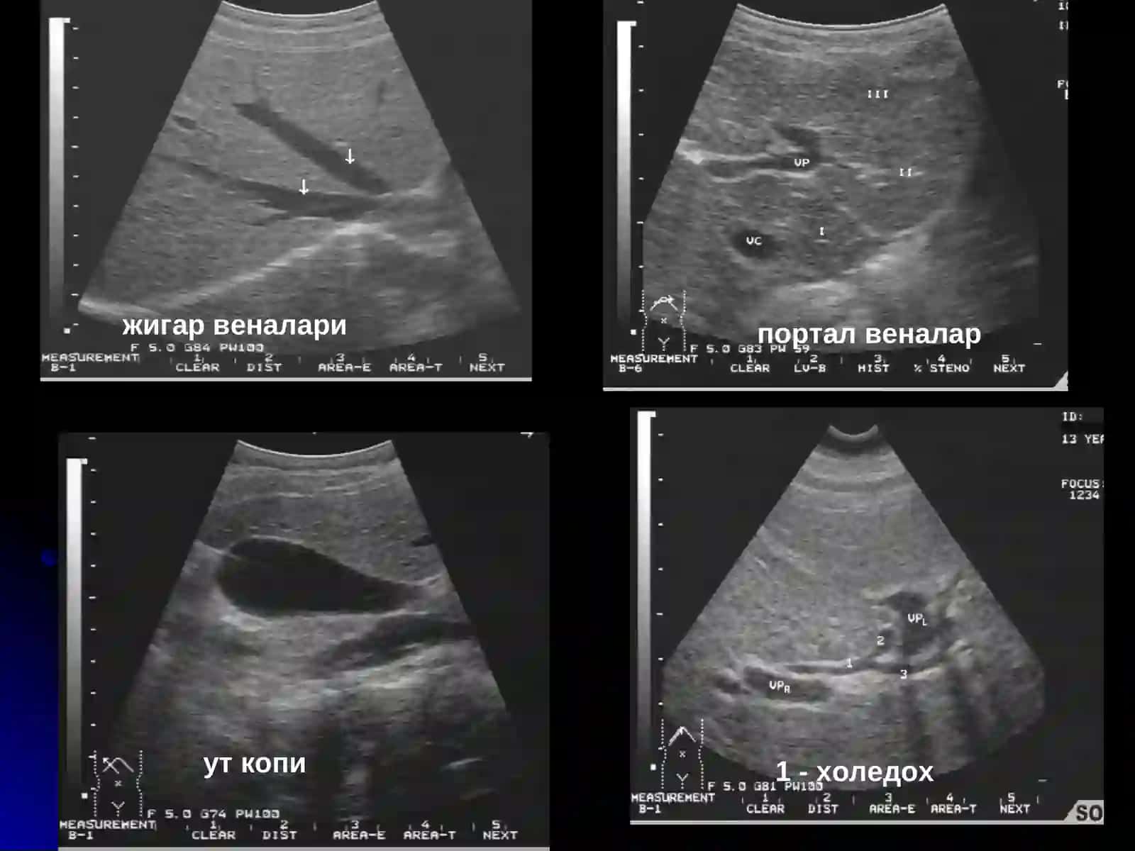 Jigar va O't yollari nur tashxisi Radiologiya 3
