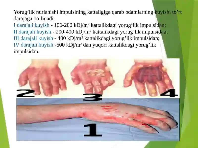 ZARB TO’LQINI, IONLASHTIRUVCHI NURLAR, YORUG’LIK AJRALISHI, JABRLANISH ZONALARI TAVSIFI 3