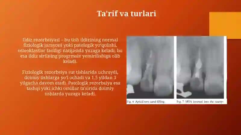 Sut tishlar ildizlarining so'rilish muddatlari 3