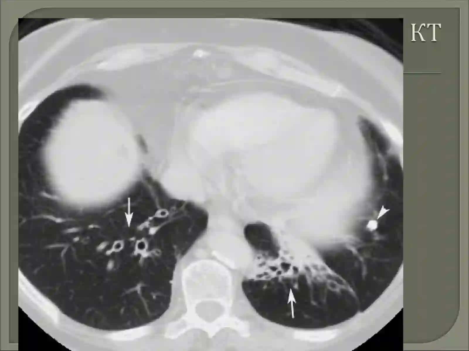 YURAK-QON TOMIRLARI KASALLIKLARIDA KOMPYUTER TOMOGRAFIYANING AXAMIYATI 3