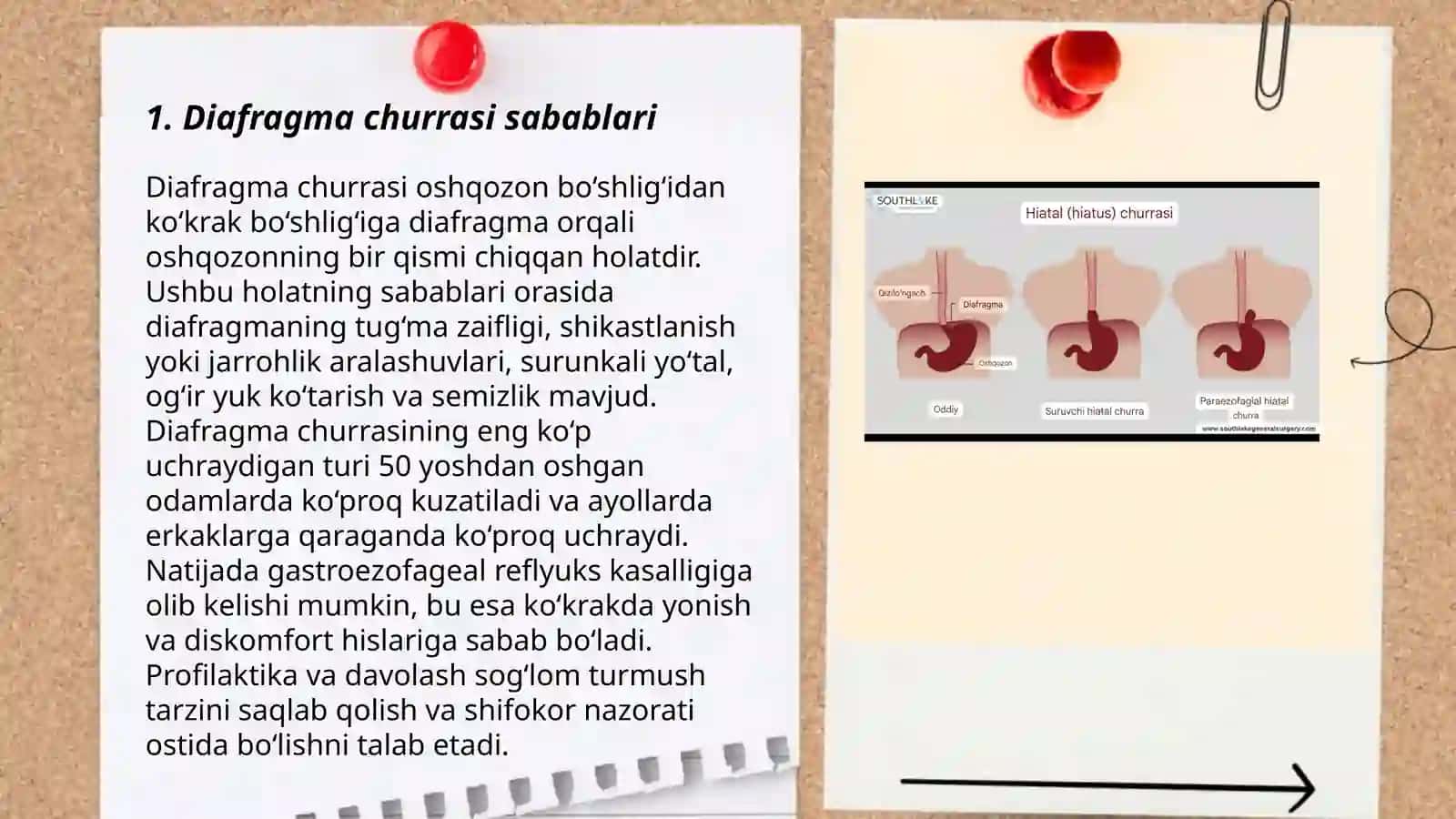 Diafragmal churralar xirurgiyasi 3