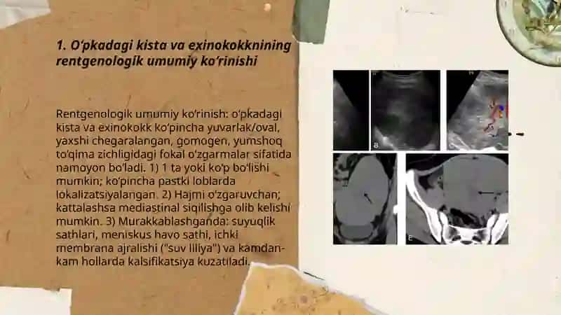 O‘PKADAGI KISTA VA EXINOKOKKNING RENTGENDIAGNOSTIKASI 3