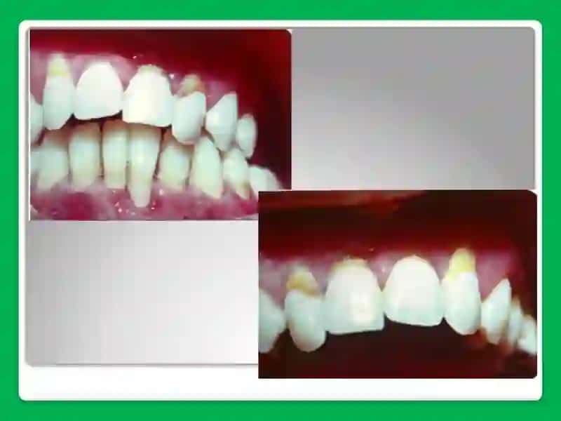 Neytropeniya 3