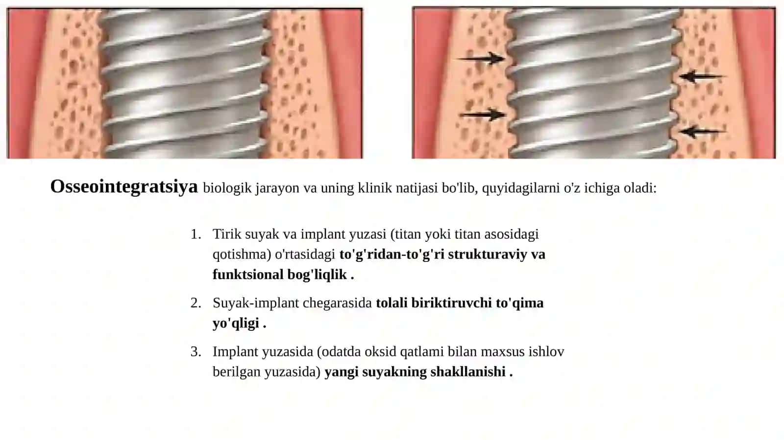Tishlarning to'liq yo'qolishi holatida implant bilan qo'llab-quvvatlanadigan tish protezlari. 3