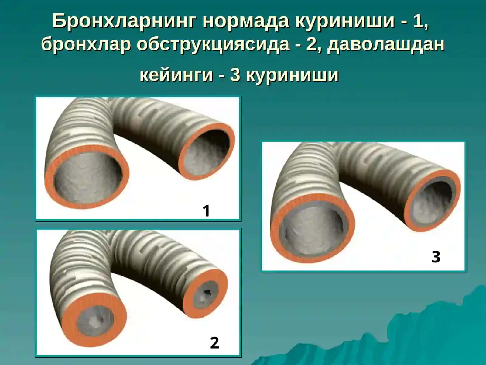 Бронхлар обструкцияси синдроми:бронхиал астма 3