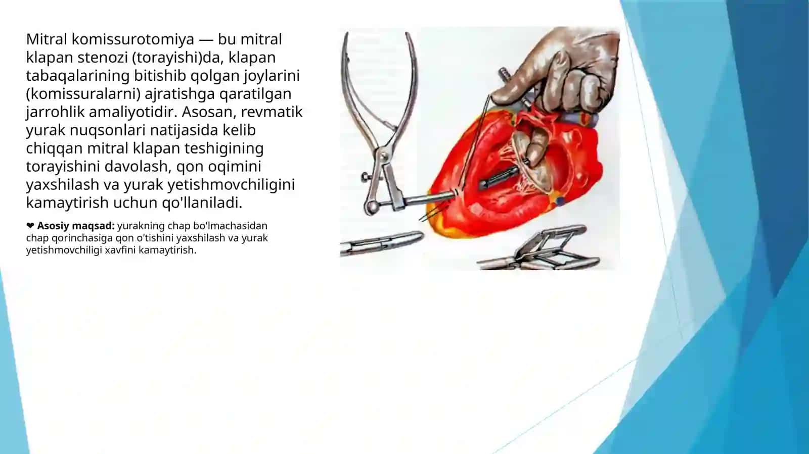 Mitral komissurotomiya va Batalov yo‘lini bog‘lashMitral stenoz operatsiyasiOchiq arteriyal kanal (ductus arteriosus) 3